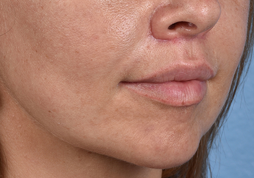 Lip Lift Before & After Gallery - Patient 797589 - Image 6