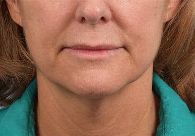 Lip Lift Before & After Gallery - Patient 173901 - Image 1