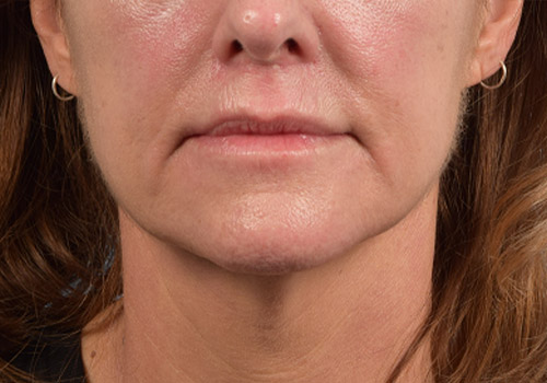 Lip Lift Before & After Gallery - Patient 173901 - Image 2