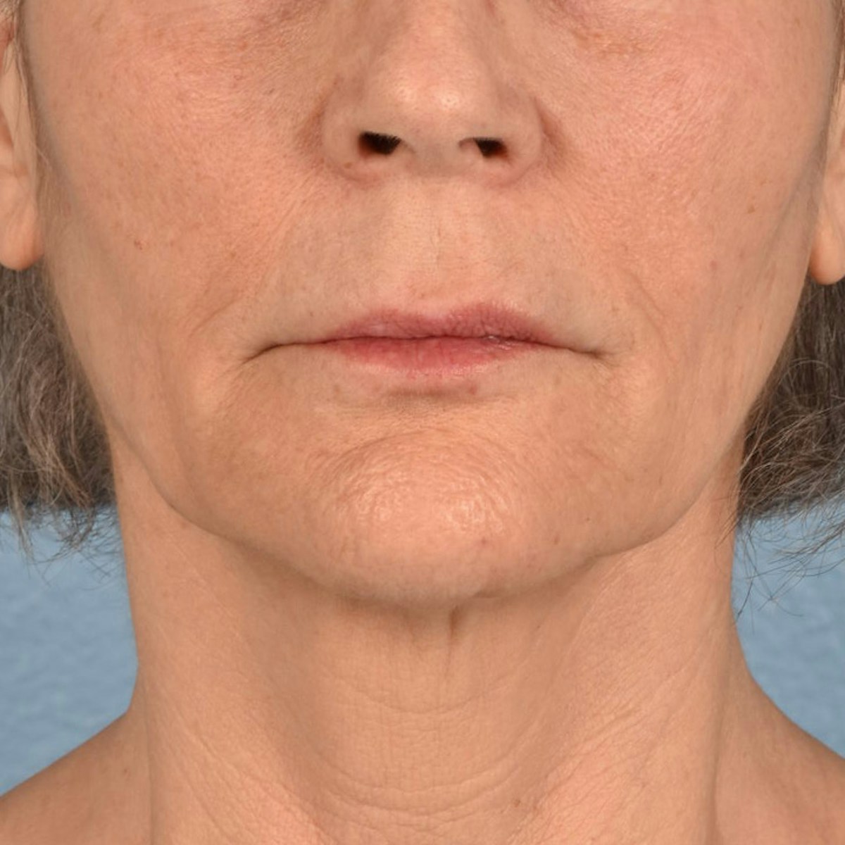 Lip Lift Before & After Gallery - Patient 197216 - Image 1