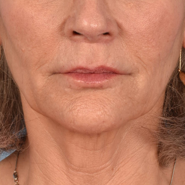 Hidden Patients Before & After Gallery - Patient 165117 - Image 2