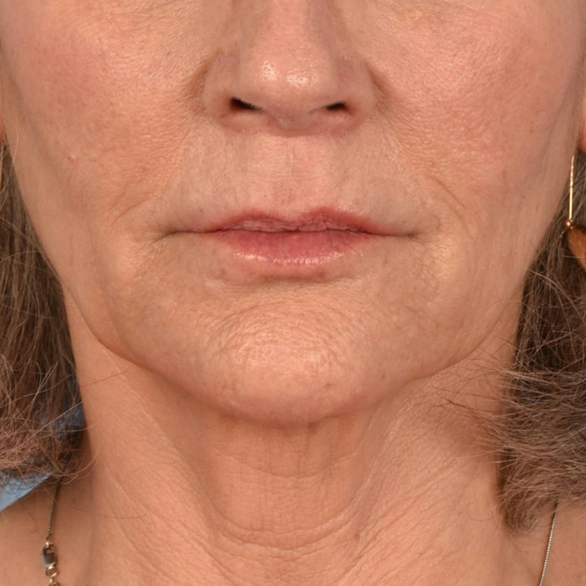 Lip Lift Before & After Gallery - Patient 197216 - Image 2