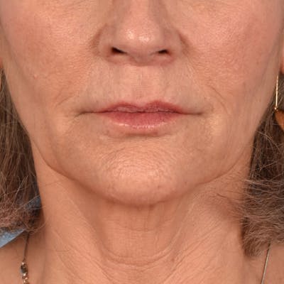 Lip Lift Before & After Gallery - Patient 197216 - Image 2