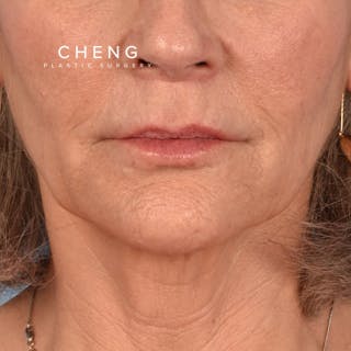 Hidden Patients Before & After Gallery - Patient 165117 - Image 2