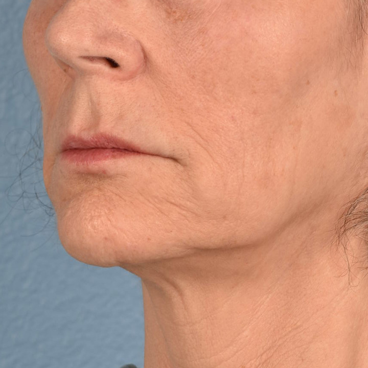 Hidden Patients Before & After Gallery - Patient 165117 - Image 3