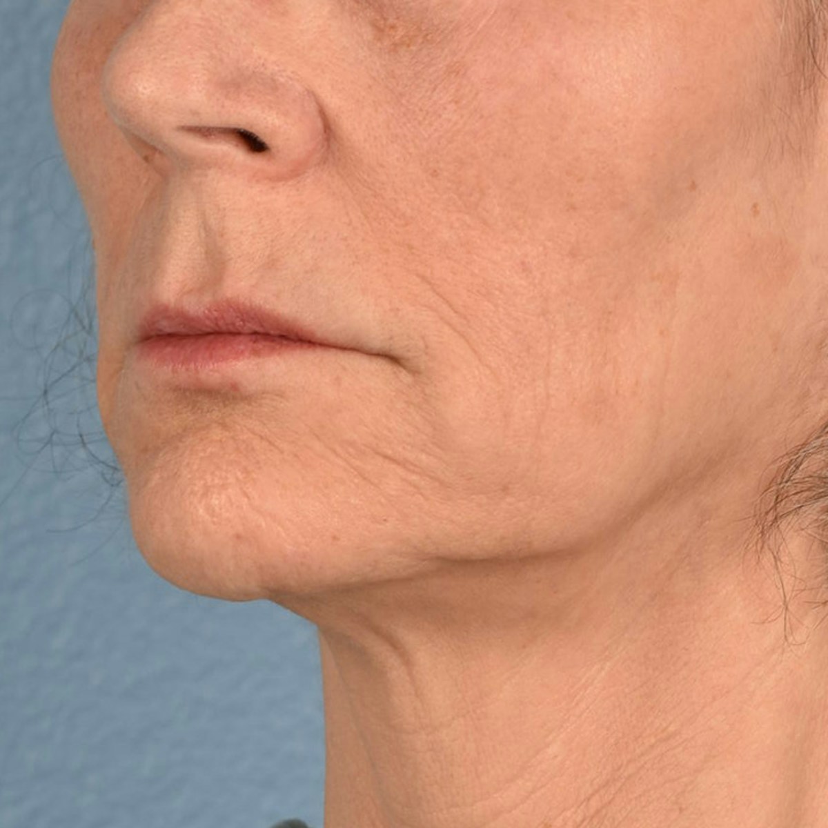 Lip Lift Before & After Gallery - Patient 197216 - Image 3