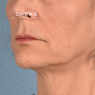 Hidden Patients Before & After Gallery - Patient 165117 - Image 3