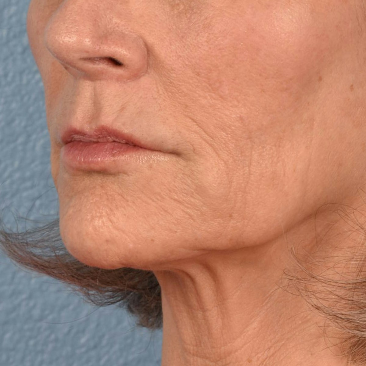 Lip Lift Before & After Gallery - Patient 197216 - Image 4