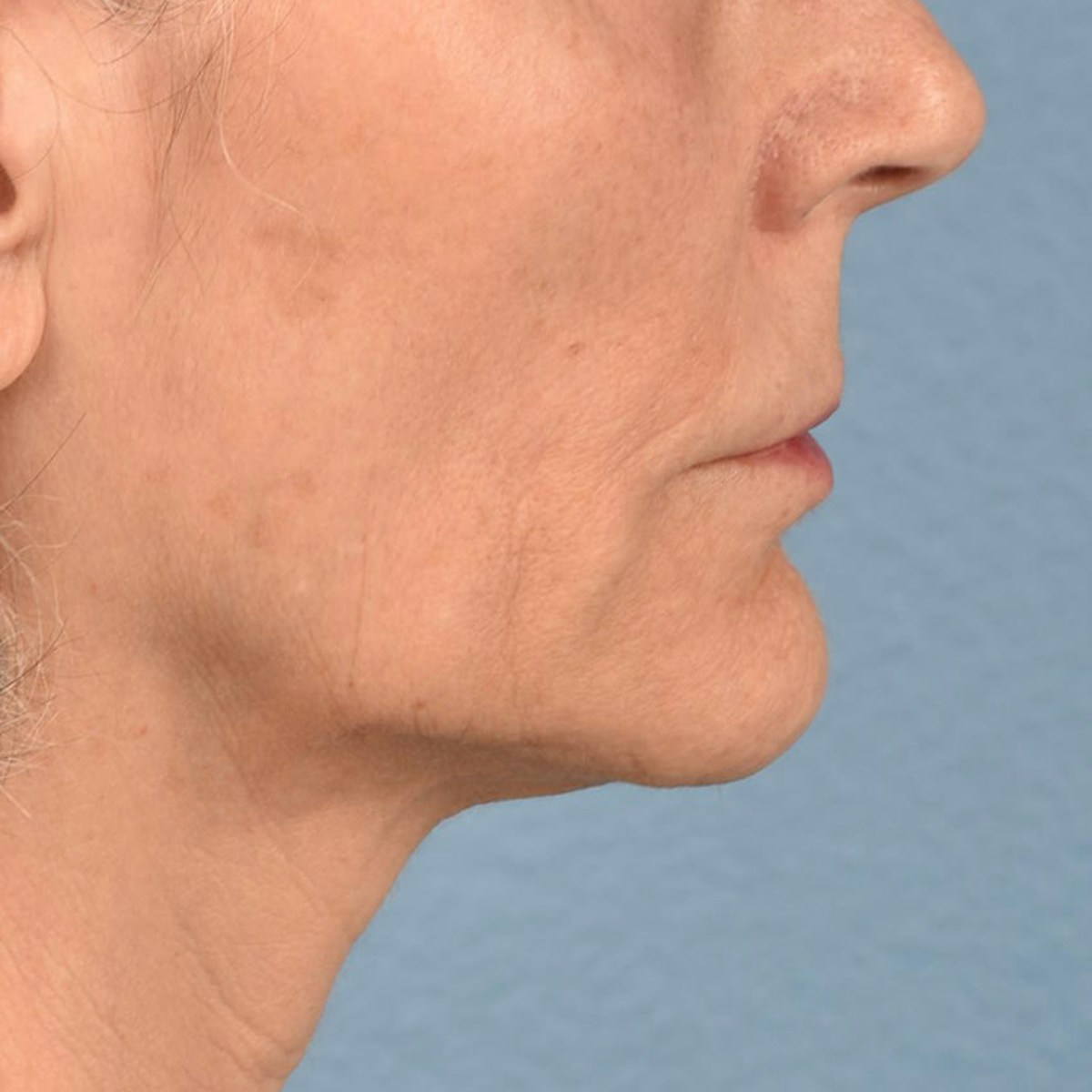 Lip Lift Before & After Gallery - Patient 197216 - Image 5