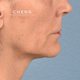 Hidden Patients Before & After Gallery - Patient 165117 - Image 5