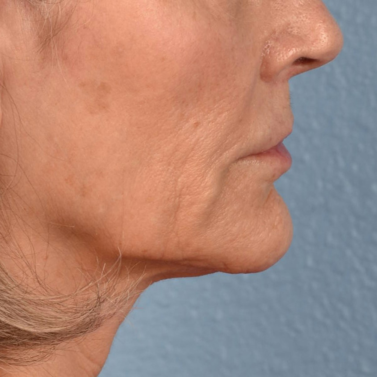 Lip Lift Before & After Gallery - Patient 197216 - Image 6
