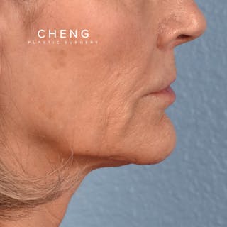Hidden Patients Before & After Gallery - Patient 165117 - Image 6