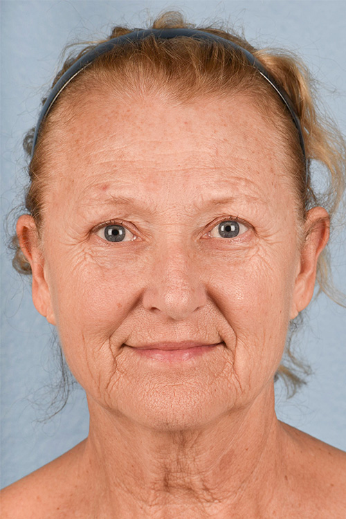 Neck Lift Before & After Gallery - Patient 302253 - Image 1