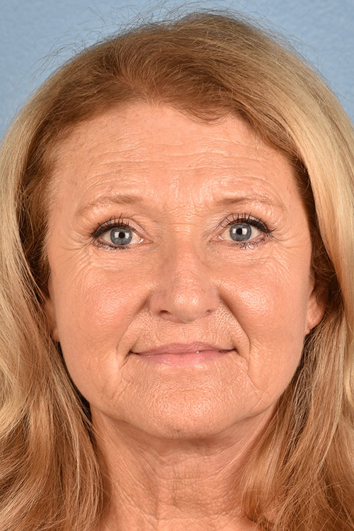 Neck Lift Before & After Gallery - Patient 302253 - Image 2