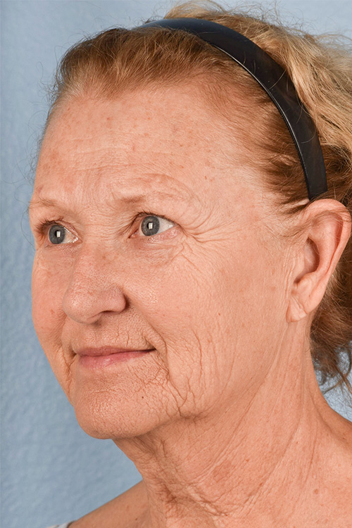 Neck Lift Before & After Gallery - Patient 302253 - Image 3