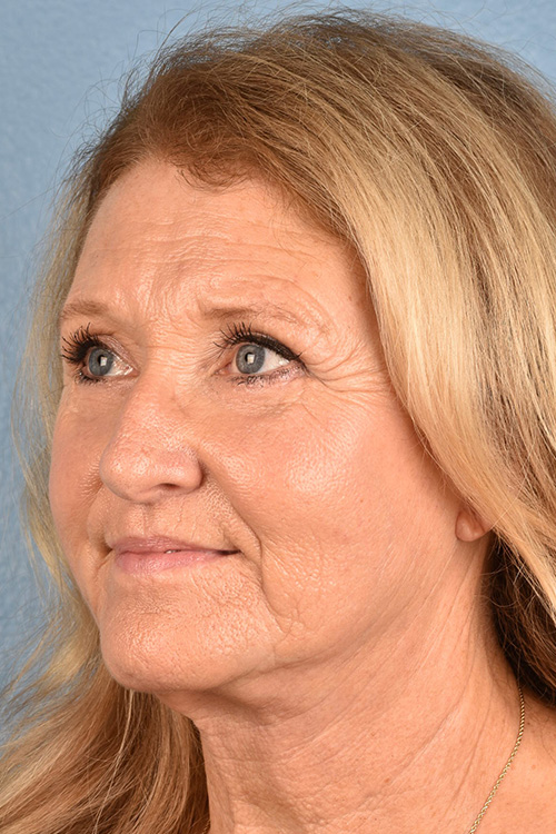 Neck Lift Before & After Gallery - Patient 302253 - Image 4