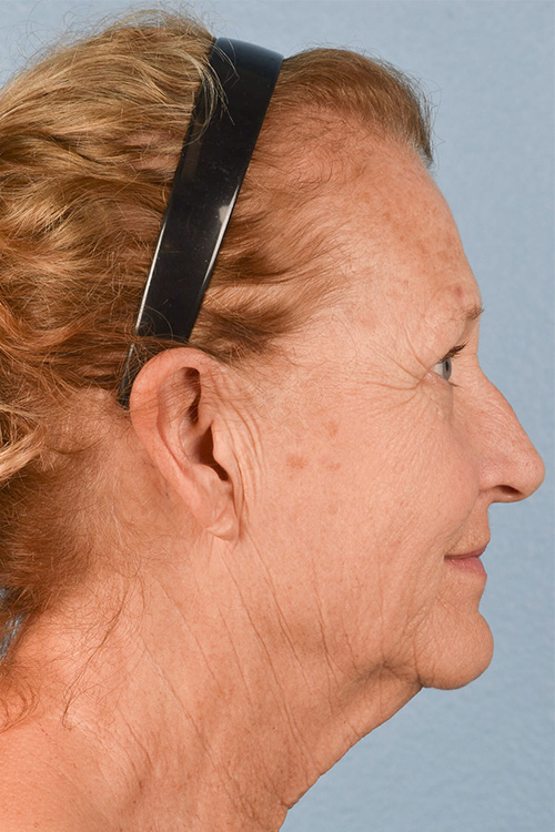 Neck Lift Before & After Gallery - Patient 302253 - Image 5
