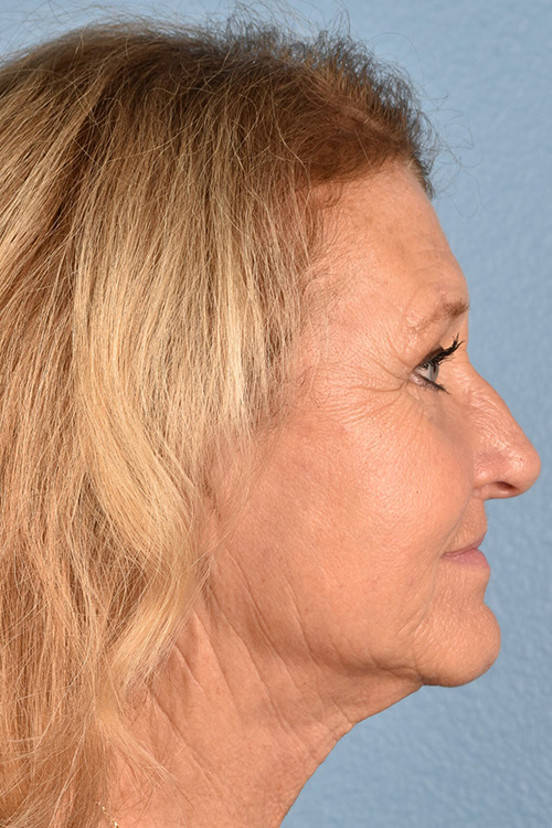 Neck Lift Before & After Gallery - Patient 302253 - Image 6