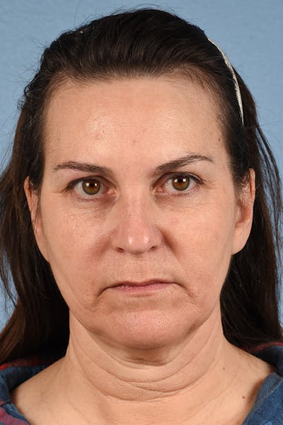 Neck Lift Before & After Gallery - Patient 169561 - Image 1