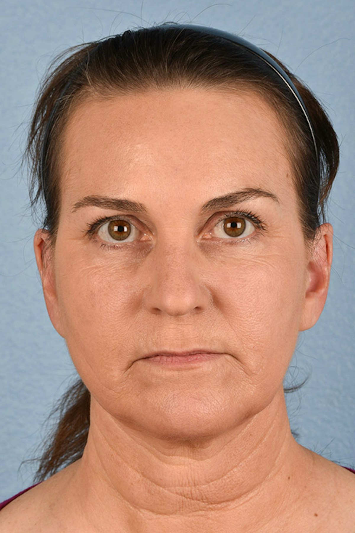 Neck Lift Before & After Gallery - Patient 169561 - Image 2
