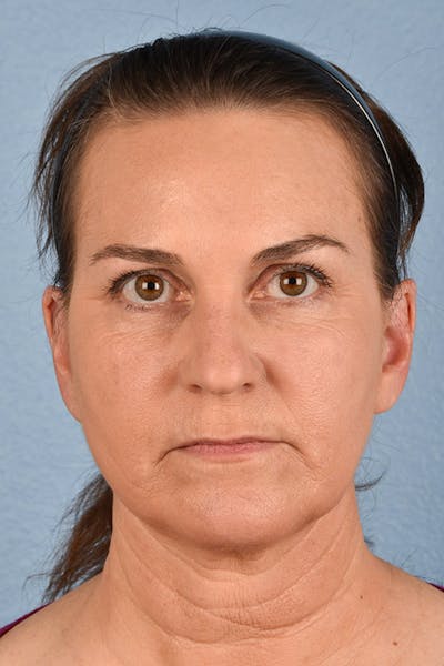 Neck Lift Before & After Gallery - Patient 169561 - Image 2