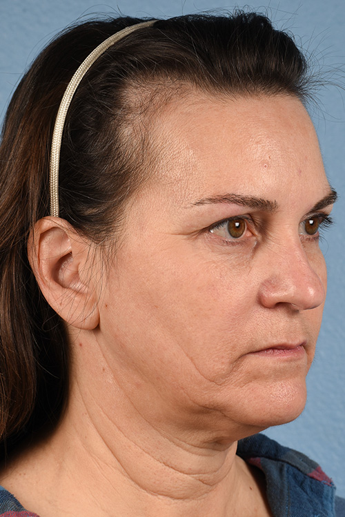 Neck Lift Before & After Gallery - Patient 169561 - Image 3