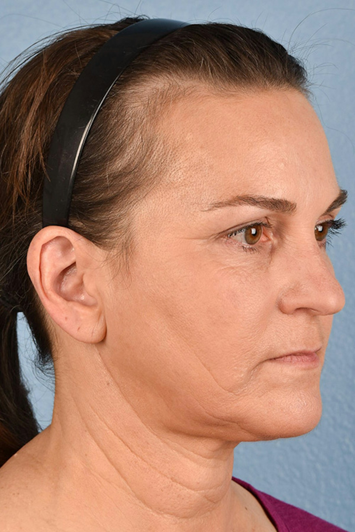 Neck Lift Before & After Gallery - Patient 169561 - Image 4