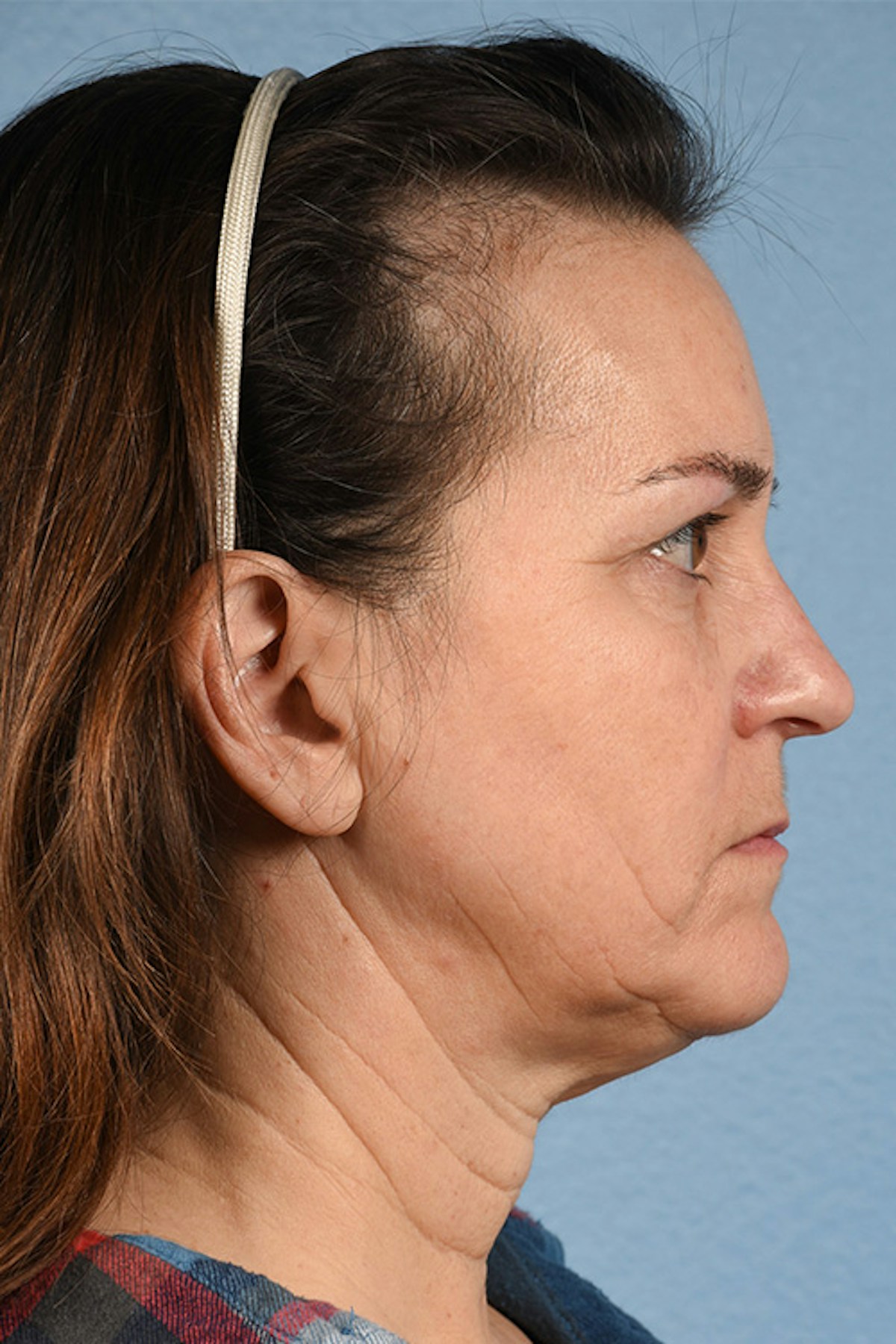 Neck Lift Before & After Gallery - Patient 169561 - Image 5