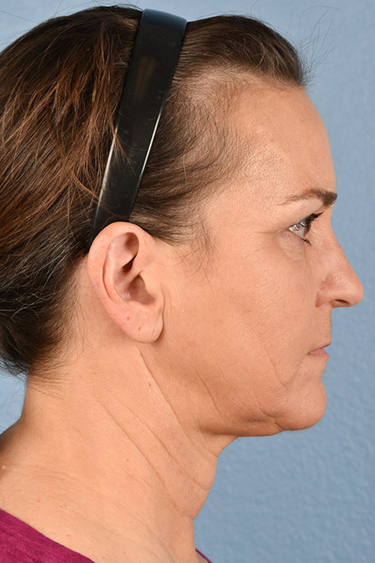 Neck Lift Before & After Gallery - Patient 169561 - Image 6