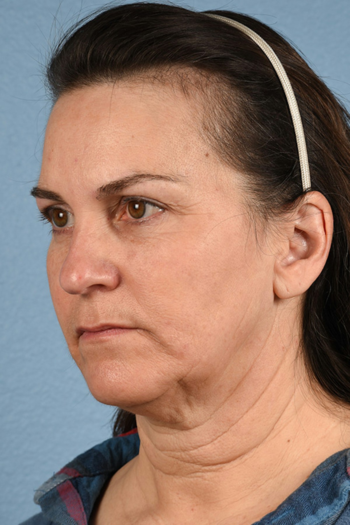 Neck Lift Before & After Gallery - Patient 169561 - Image 7