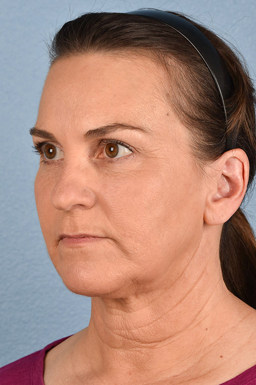 Neck Lift Before & After Gallery - Patient 169561 - Image 8