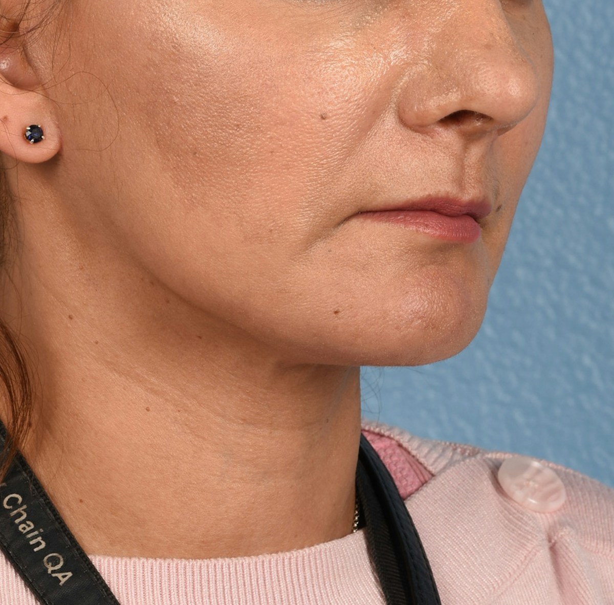 Neck Lift Before & After Gallery - Patient 424030 - Image 4