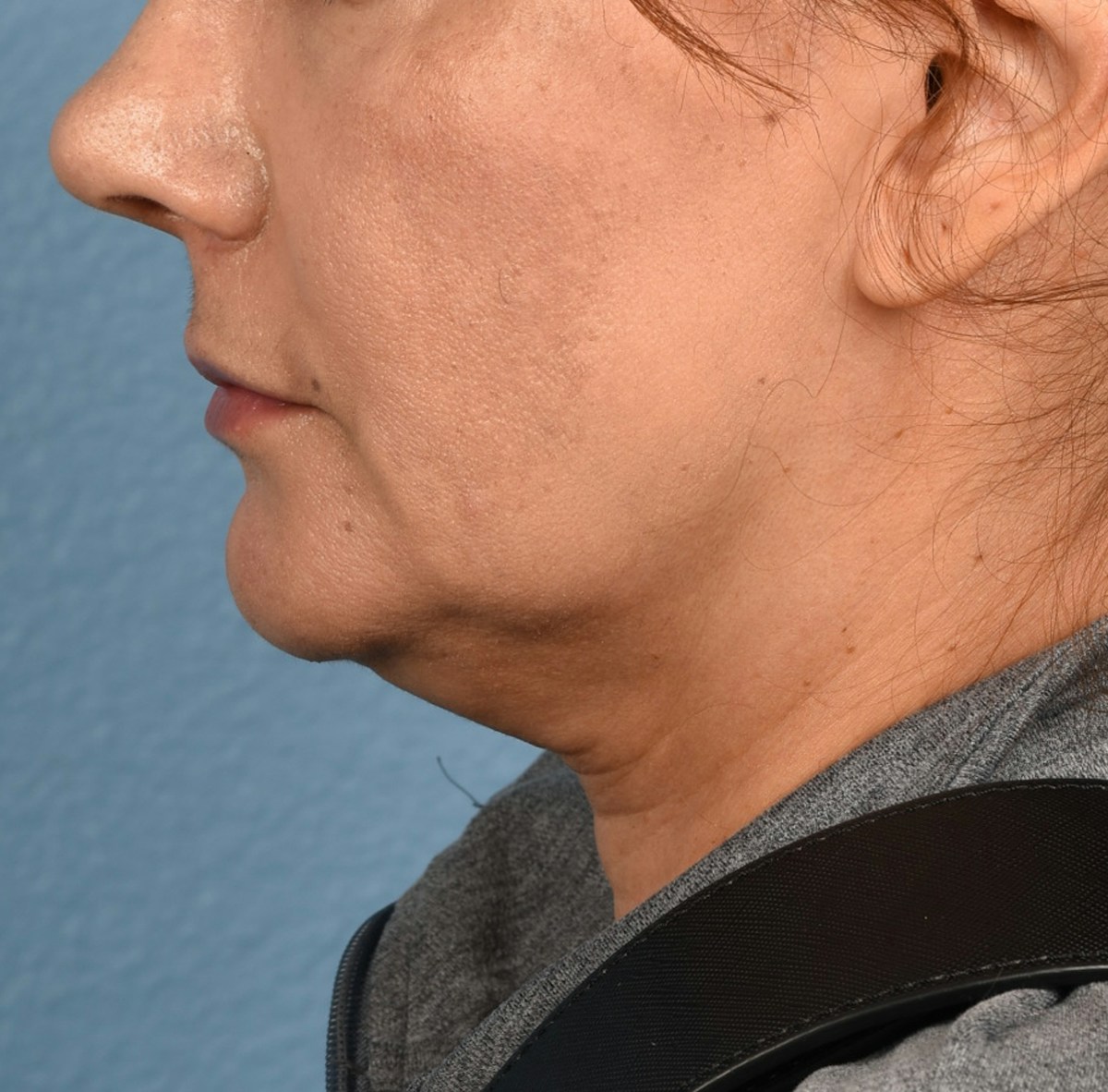 Neck Lift Before & After Gallery - Patient 424030 - Image 7