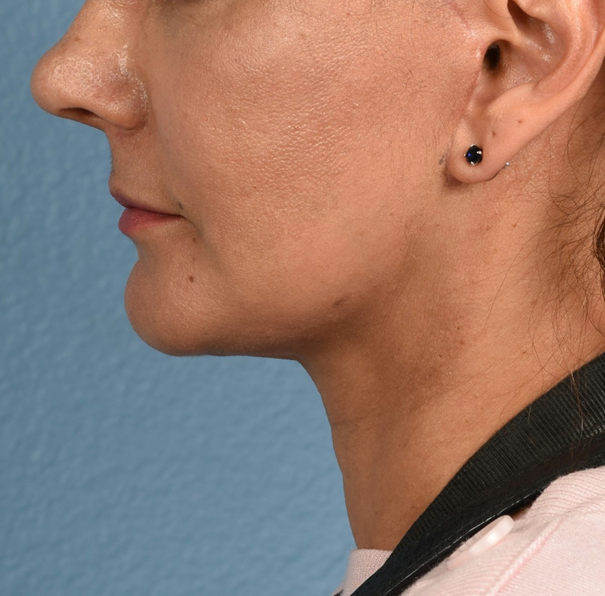 Neck Lift Before & After Gallery - Patient 424030 - Image 8