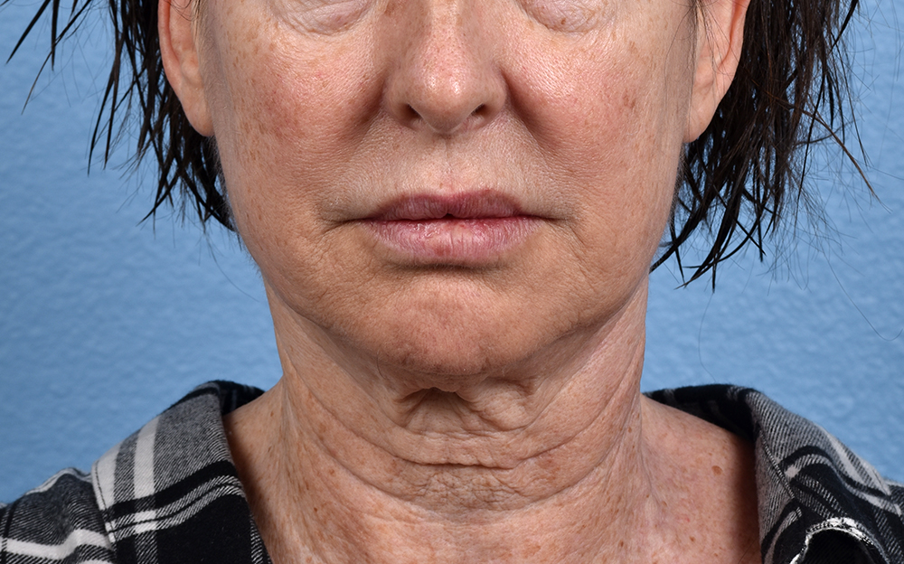 Neck Lift Before & After Gallery - Patient 238925 - Image 1