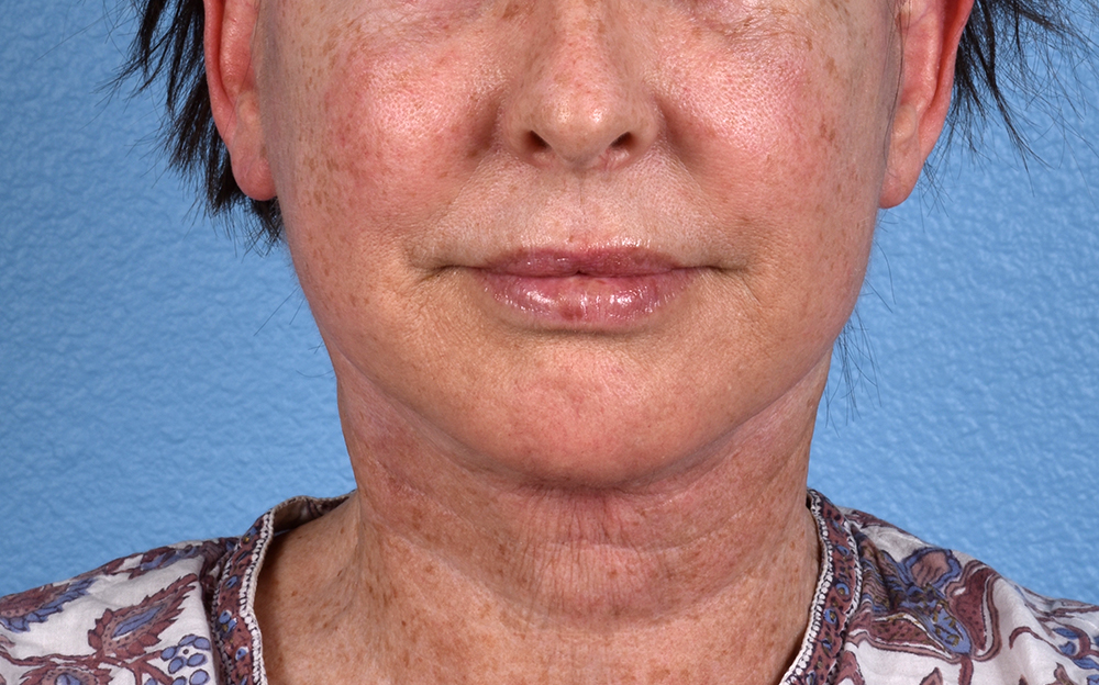 Neck Lift Before & After Gallery - Patient 238925 - Image 2