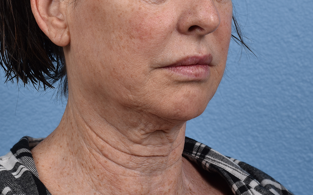 Neck Lift Before & After Gallery - Patient 238925 - Image 3