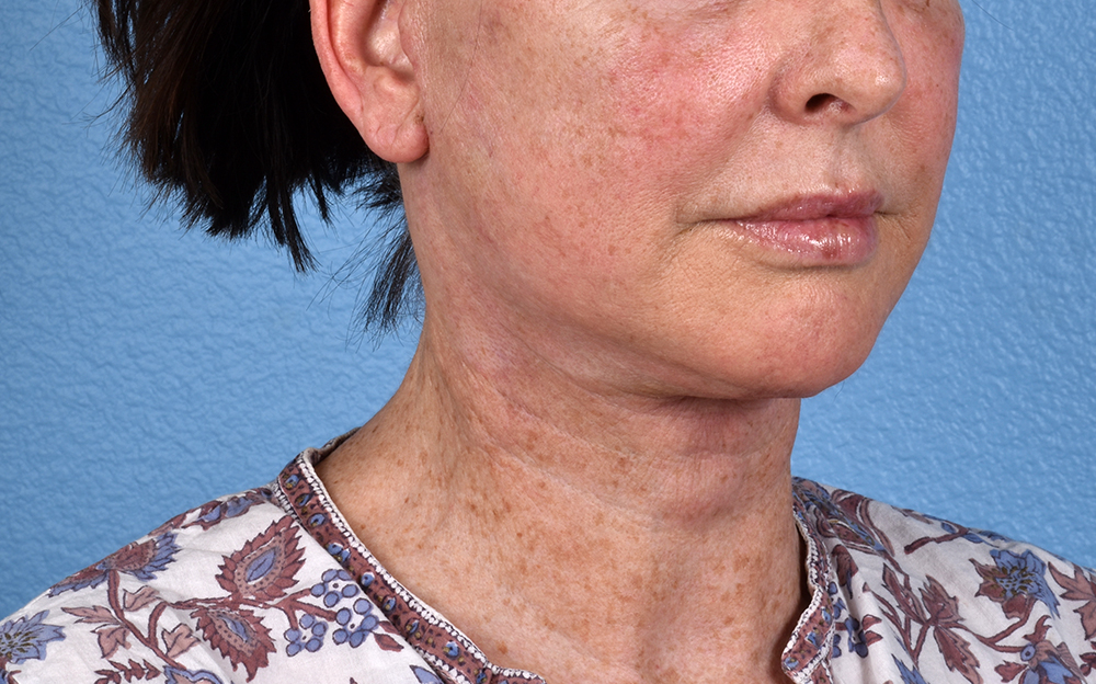 Neck Lift Before & After Gallery - Patient 238925 - Image 4
