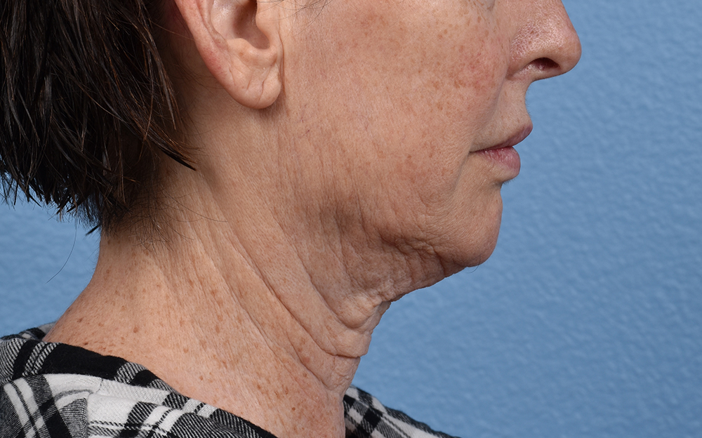 Neck Lift Before & After Gallery - Patient 238925 - Image 5