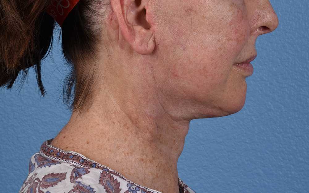 Neck Lift Before & After Gallery - Patient 238925 - Image 6
