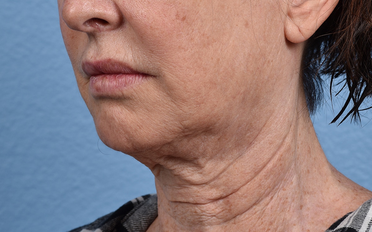 Neck Lift Before & After Gallery - Patient 238925 - Image 7