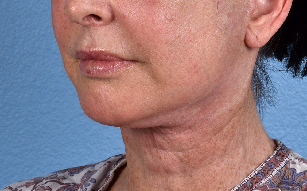 Neck Lift Before & After Gallery - Patient 238925 - Image 8