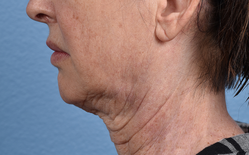 Neck Lift Before & After Gallery - Patient 238925 - Image 9