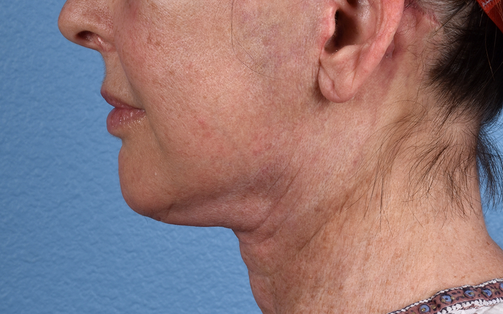 Neck Lift Before & After Gallery - Patient 238925 - Image 10