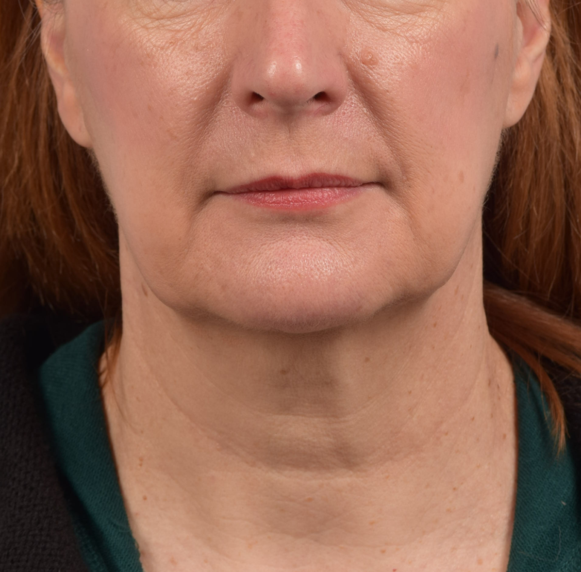 Neck Lift Before & After Gallery - Patient 204140 - Image 1