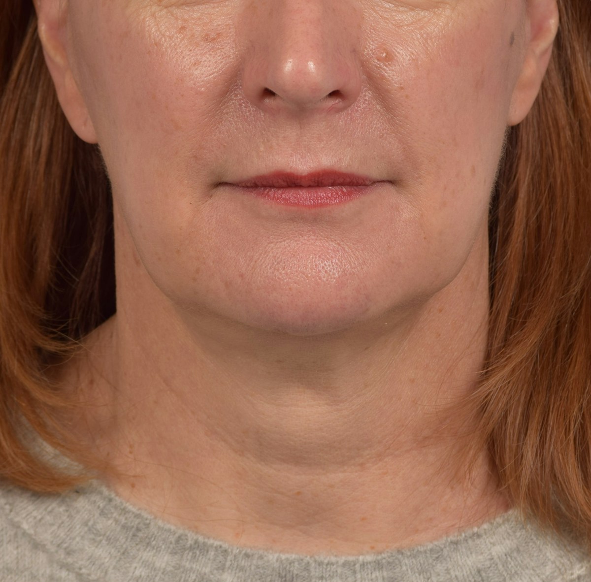 Neck Lift Before & After Gallery - Patient 204140 - Image 2