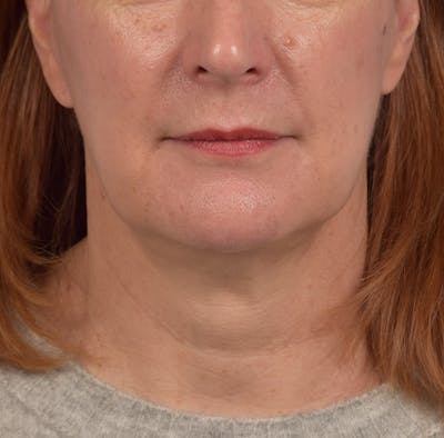 Neck Lift Before & After Gallery - Patient 204140 - Image 2