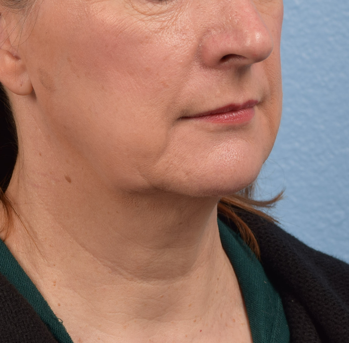 Neck Lift Before & After Gallery - Patient 204140 - Image 3