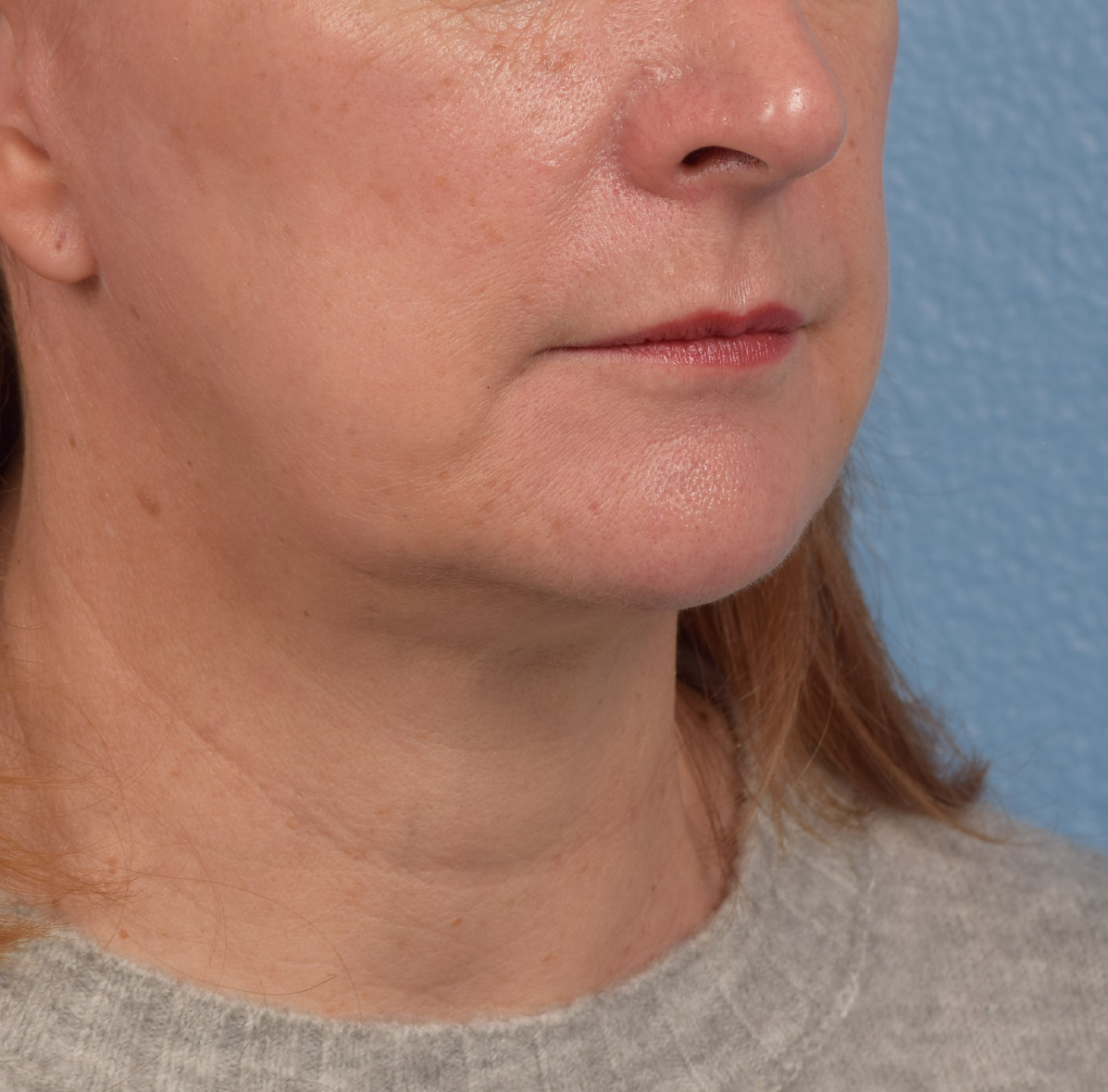 Neck Lift Before & After Gallery - Patient 204140 - Image 4