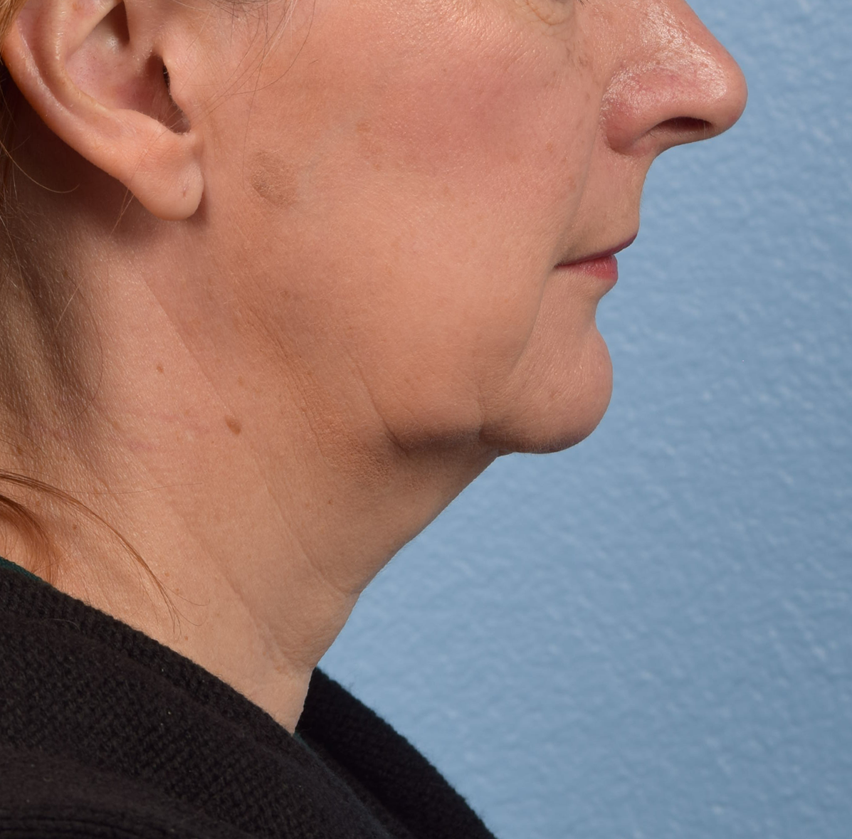 Neck Lift Before & After Gallery - Patient 204140 - Image 5